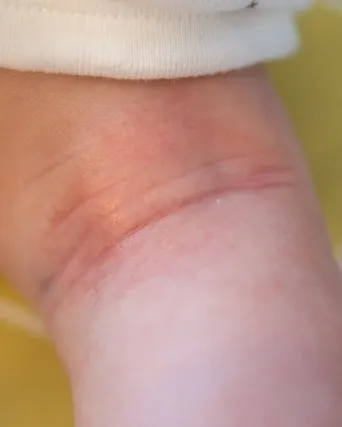 汗もができやすい人、できにくい人。